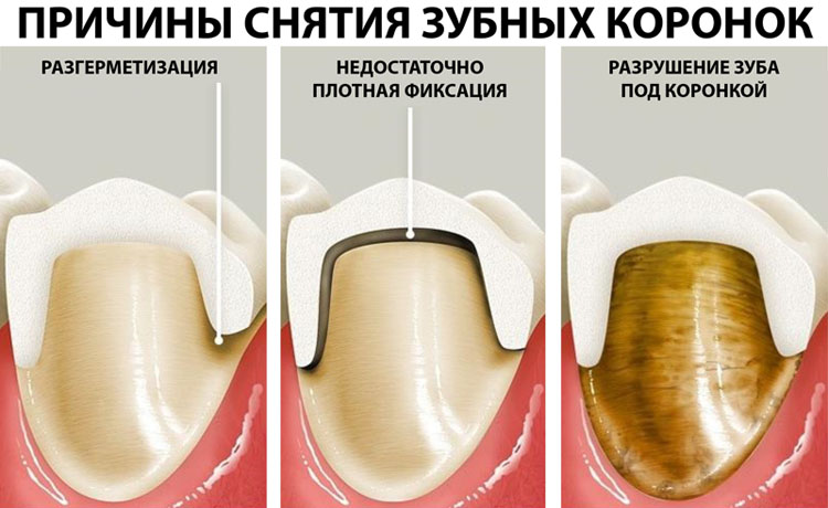 Что делать если болит зуб под коронкой?